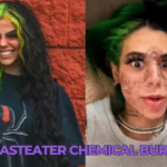 beasteater chemical burns
